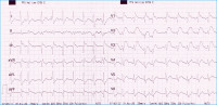 Abbildung 1: Akut-EKG