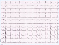 Abbildung 2: EKG
