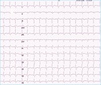 Abbildung 3: EKG - Lysetherapie