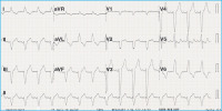 Abbildung 1: EKG