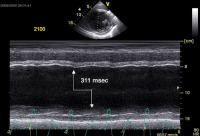 Abbildung 7: M-Mode linker Ventrikel - Septal-to-Posterior-Wall Motion Delay  (SPWMD)