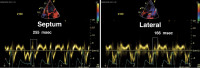 Abbildung 14: PW-Gewebedoppler (Septum/lateral)