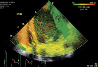 Abbildung 17: Tissue Synchronization Imaging (TSI)