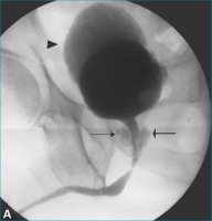 Abbildung 3-a: Cystourethrogram