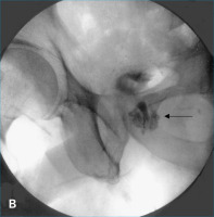 Abbildung 3-b: Cystourethrogram