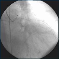 Abbildung 3: Stent-Leeraufnahme