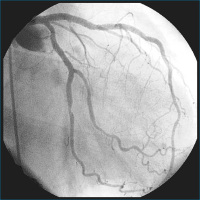 Abbildung 4: LAD-Stent