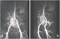 Abbildung 1a-b: MR-Angiographie - A. iliaca communis