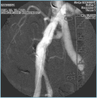 Abbildung 3: Angiographie - A. iliaca communis