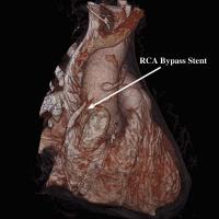 Abbildung 6: RCA-Bypass-Stent