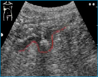 Abbildung 1: Sonographische Darstellung eines Divertikels im Colon sigmoideum