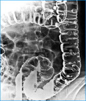 Abbildung 3: Kolonkontrasteinlauf mit Darstellung der Divertikel im Colon sigmoideum und ascendens