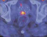 Abbildung 1: F18-Cholin-PET mit CT-Fusion