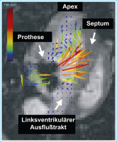 Abbildung 5: Kippscheibenprothese