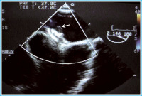 Abbildung 2: Thrombus