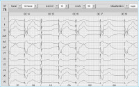 Abbildung 3: EKG