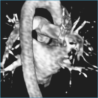 Abbildung 4: Spitzenpulmonalvene - Magnetresonanzangiographie