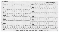 Abbildung 1: EKG