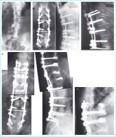 Abbildung 1a-e: Osteoporose