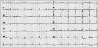 Abbildung 1: EKG