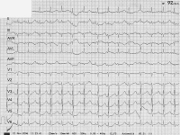 Abbildung 1: EKG