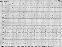 Abbildung 3: EKG