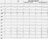 Abbildung 1: EKG
