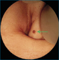 Abbildung 1: Endometriose