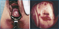 Abbildung 2: Endometriose