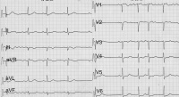 Abbildung 1: EKG