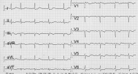 Abbildung 2b: EKG