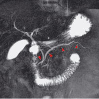 Abbildung 1b: Ductus pancreaticus
