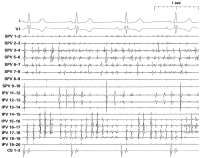 Abbildung 1: EKG-Ableitung