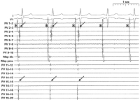 Abbildung 4: EKG-Ableitung