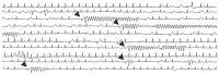 Abbildung 1: EKG