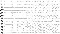 Abbildung 2: EKG