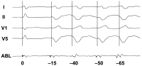 Abbildung 4: EKG