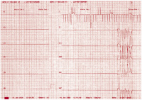 Abbildung 1: EKG