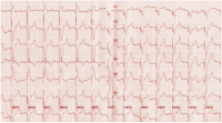 Abbildung 3: EKG