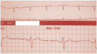 Abbildung 1: EKG