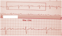 Abbildung 2: EKG