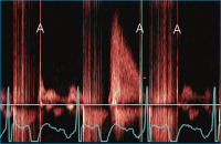 Abbildung 3: CW-Doppler
