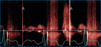 Abbildung 4: CW-Doppler