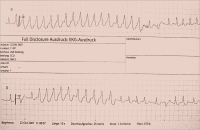Abbildung 1: EKG