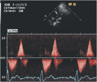 Abbildung 4: Pulmonalarterie