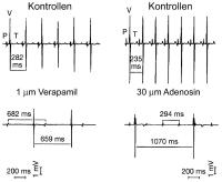 Abbildung 3: Wirkung von Adenosin