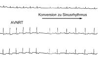 Abbildung 4: Adenosin - AVNRT