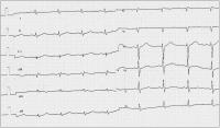 Abbildung 1: Brugada-Syndrom - EKG