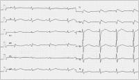 Abbildung 2: Brugada-Syndrom - Ajmalin-Test