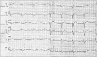 Abbildung 3: Brugada-Syndrom - Ajmalin